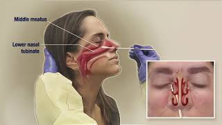 Medical  Huge Booger Inside Nose Removal Medical [upl. by Dong]