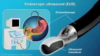 Understanding EUSFNA [upl. by Erdreid]