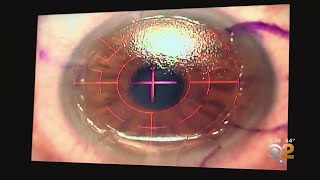 FDA Finds Lasik Eye Surgery Complications [upl. by Ibed823]