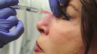 Nonsurgical Rhinoplasty [upl. by Edee]