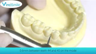 Work Tips Interproximal Enamel Stripping IPR） [upl. by February]